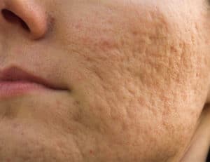 acne scars 400x308 300x231 1