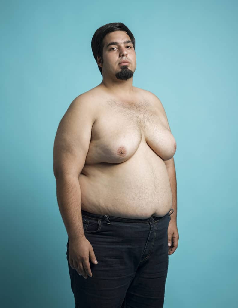 man before male breast reduction surgery