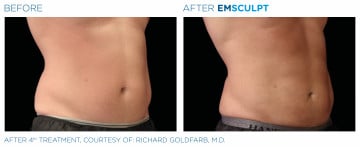 man’s bare stomach before and after emsculpt treatment, abdominal muscles more defined after procedure