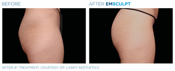 Emsculpt Booty Before and After 2