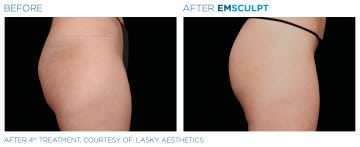 side view of woman’s bare rear end before and after emsculpt, skin tighter after procedure