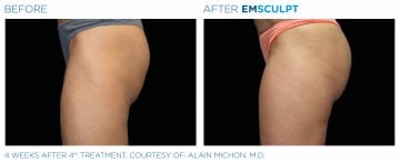 Emsculpt Booty Before and After