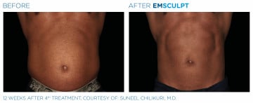 Emsculpt Male