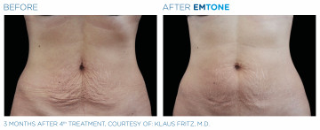 Emtone Before and After Belly