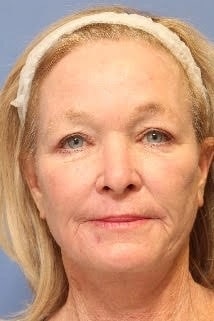 Fusion Facelift after