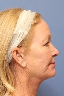Fusion Facelift after (Other Side)