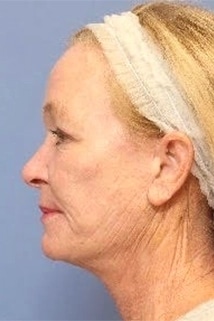 Fusion Facelift after