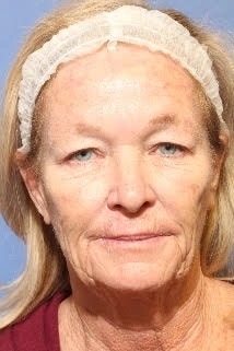 Fusion Facelift before