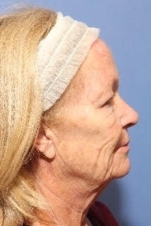 Fusion Facelift before (side face)