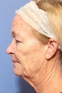 Fusion Facelift before side view