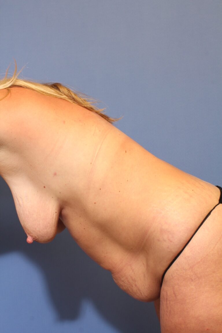 Before Image: Mommy Makeover - left-side