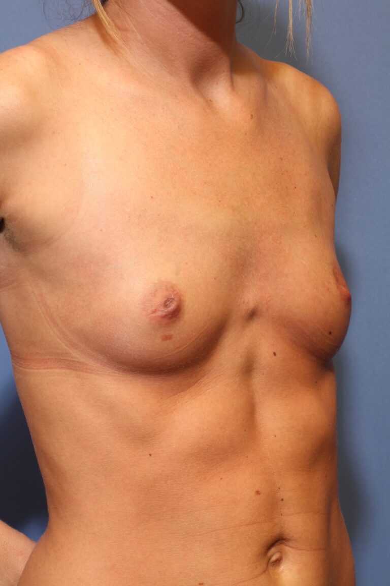 Before Image: Breast Augmentation - right-front-oblique