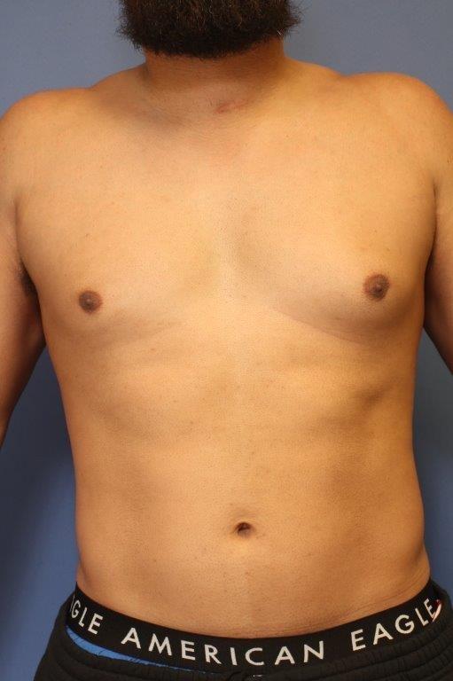 Before Image: Male Breast Reduction - front