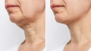Before and after neck lift in Louisville, KY