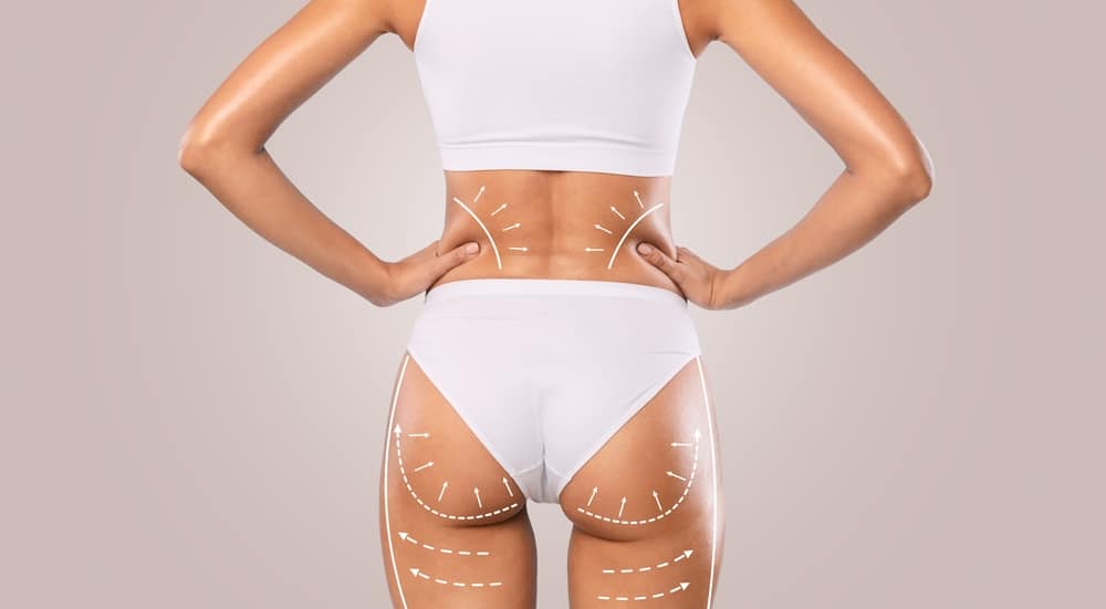 A back view of a woman in white underwear showing the results of a Brazilian Butt Lift