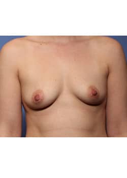 Before Image: Breast Augmentation - front