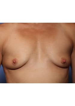 Breast Augmentation