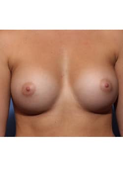 After Image: Breast Augmentation - front