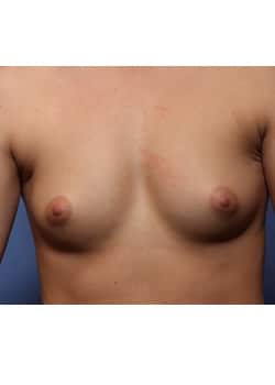 Before Image: Breast Augmentation - front