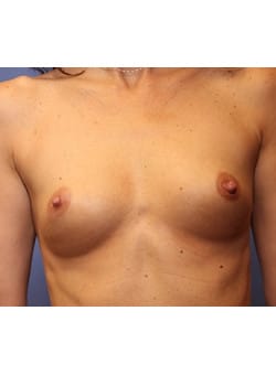 Before Image: Breast Augmentation - front