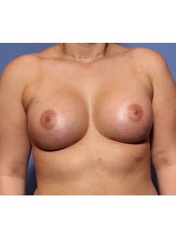 After Image: Breast Augmentation - front
