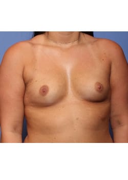 Before Image: Breast Augmentation - front