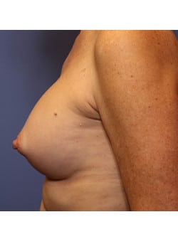 Breast Augmentation