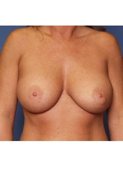 After Image: Breast Augmentation - front
