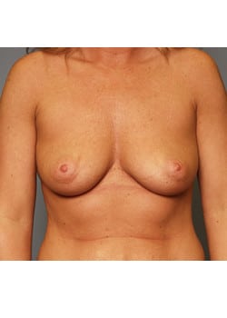 Before Image: Breast Augmentation - front