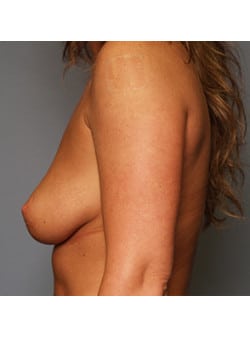 Breast Augmentation