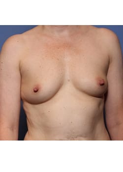 Before Image: Breast Augmentation - front
