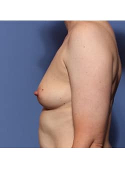 Breast Augmentation