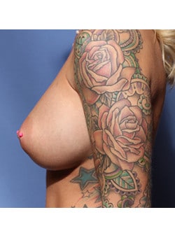 Breast Augmentation