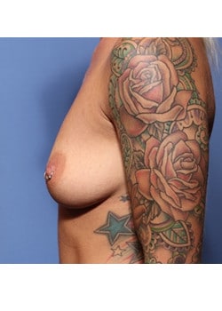 Breast Augmentation