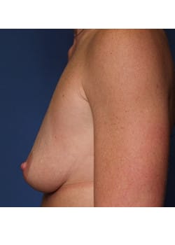 Breast Augmentation