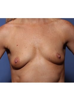 Before Image: Breast Augmentation - front