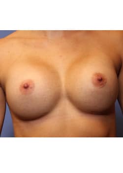 After Image: Breast Augmentation - front