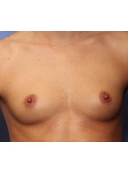 Before Image: Breast Augmentation - front