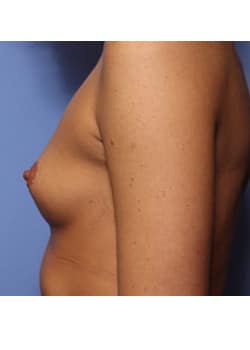 Breast Augmentation