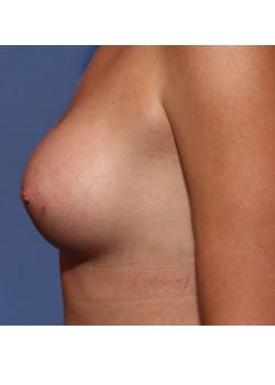 Breast Augmentation