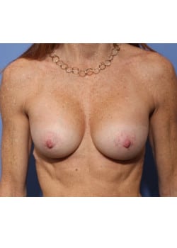 After Image: Breast Augmentation - front
