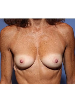 Before Image: Breast Augmentation - front