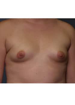 Before Image: Breast Augmentation - front