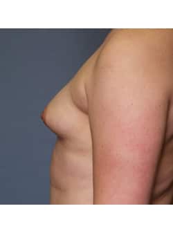 Breast Augmentation