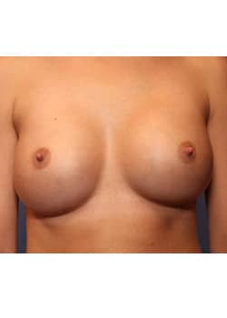 After Image: Breast Augmentation - front