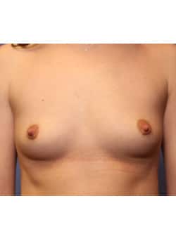 Before Image: Breast Augmentation - front