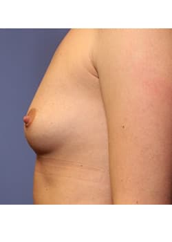 Breast Augmentation