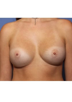 After Image: Breast Augmentation - front