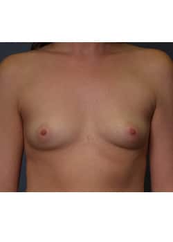 Before Image: Breast Augmentation - front