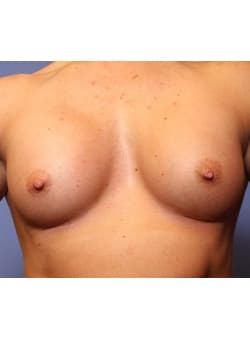 After Image: Breast Augmentation - front